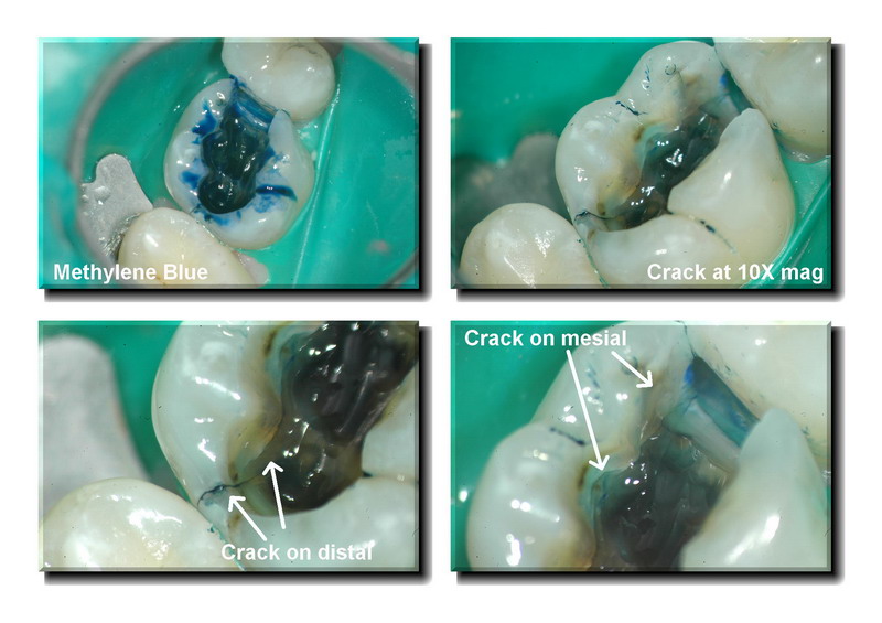 Cracked tooth pg 3 edited_resize.jpg